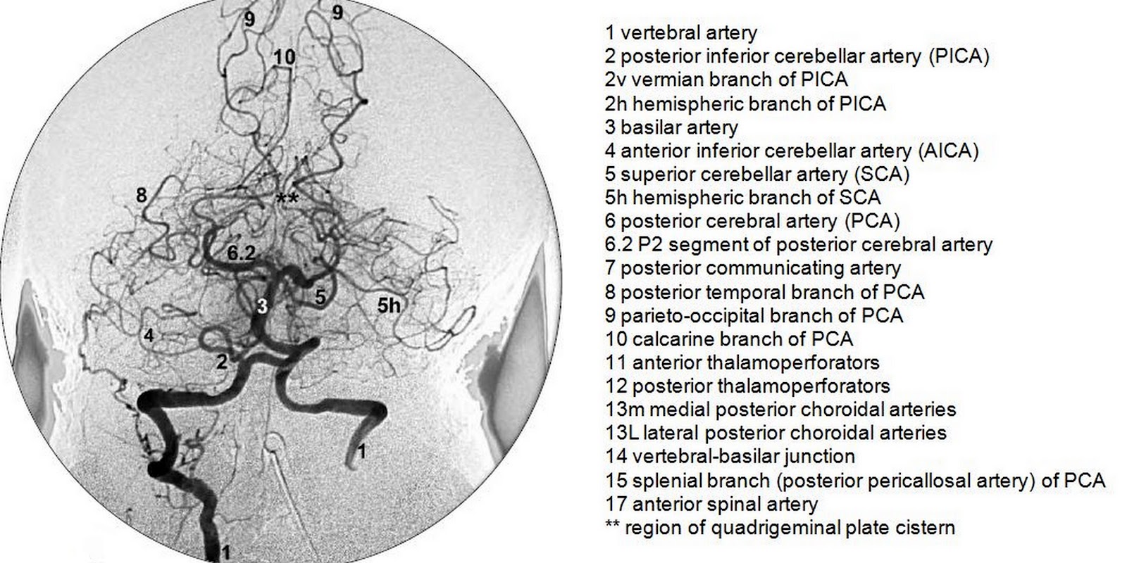 Vertebrobasilar angiography (DSA)